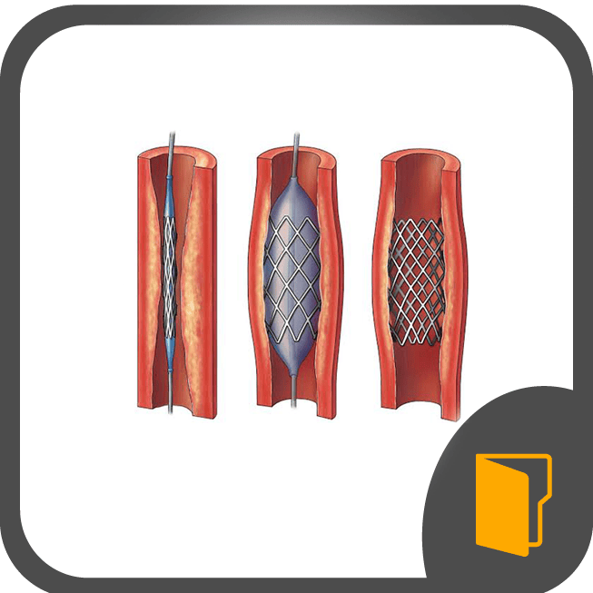 Angioplasty & Stenting