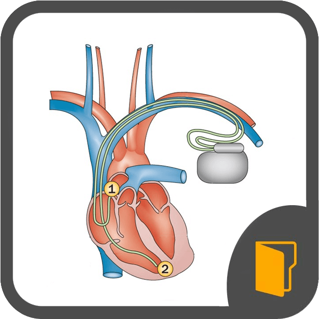 Bradyarrhythmias & Devices