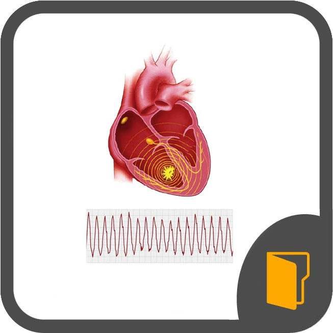 Ventricular Arrhythmias